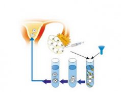 试管取卵一代还是二代好？