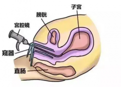 宫腔镜到底是什么？